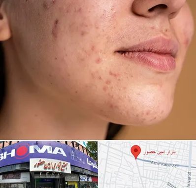 درمان جای جوش در امین حضور