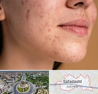 درمان جای جوش در صفادشت