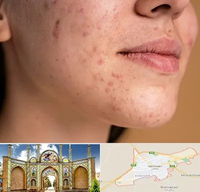 درمان جای جوش در سمنان