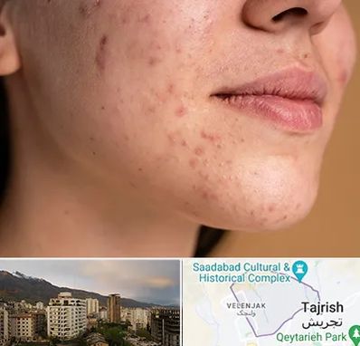 درمان جای جوش در زعفرانیه 