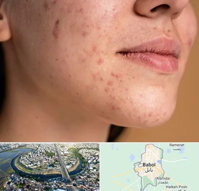 درمان جای جوش در بابل