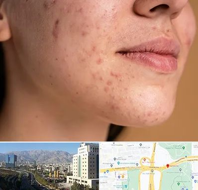 درمان جای جوش در حقانی 