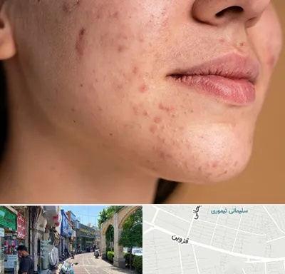 درمان جای جوش در خیابان قزوین