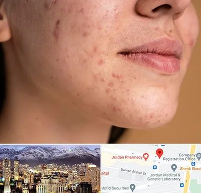 درمان جای جوش در جردن 