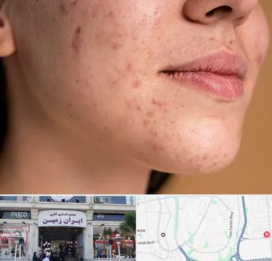 درمان جای جوش در ایران زمین