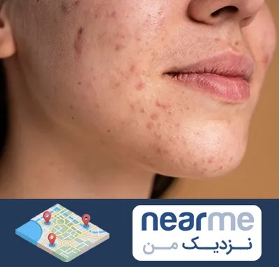 درمان جای جوش در نزدیک من