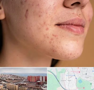 درمان جای جوش در سهند تبریز