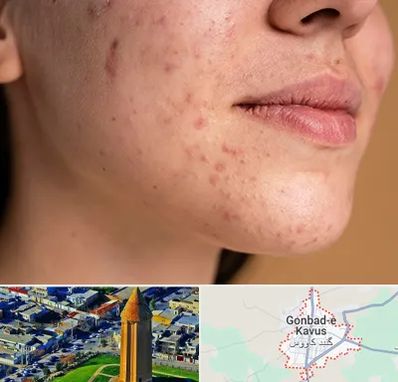 درمان جای جوش در گنبد کاووس