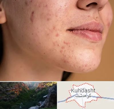 درمان جای جوش در کوهدشت