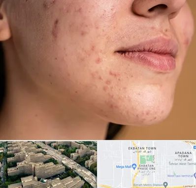 درمان جای جوش در اکباتان 