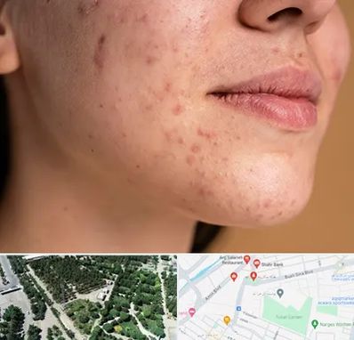 درمان جای جوش در سالاریه قم