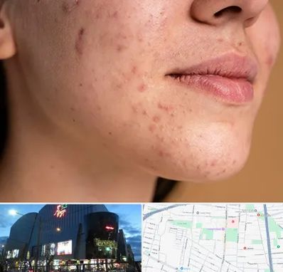 درمان جای جوش در بلوار اباذر