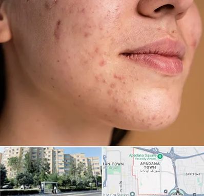 درمان جای جوش در آپادانا