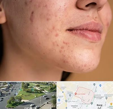 درمان جای جوش در شاهین ویلا کرج 