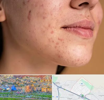 درمان جای جوش در رشدیه تبریز