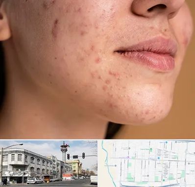 درمان جای جوش در 17شهریور