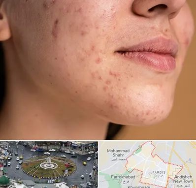 درمان جای جوش در فردیس کرج 