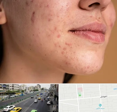 درمان جای جوش در خیابان دامپزشکی