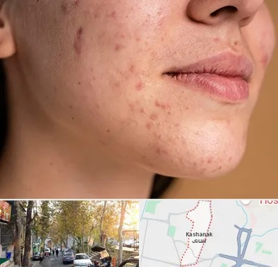 درمان جای جوش در کاشانک