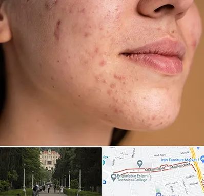 درمان جای جوش در بلوار معلم رشت 