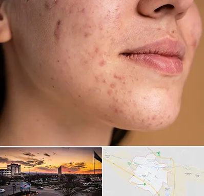 درمان جای جوش در قوچان