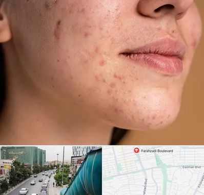 درمان جای جوش در بلوار فرحزادی