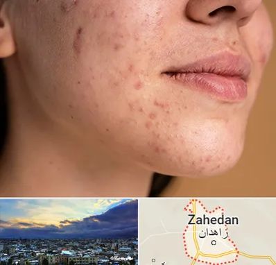 درمان جای جوش در زاهدان