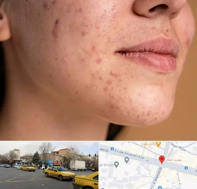 درمان جای جوش در شهناز تبریز