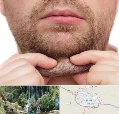 ساکشن غبغب در شیروان