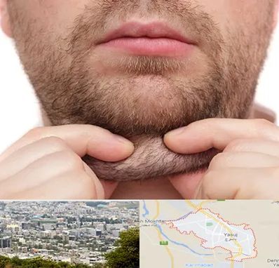 ساکشن غبغب در یاسوج