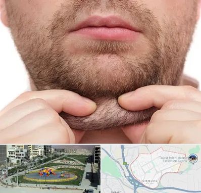 ساکشن غبغب در مرزداران تبریز