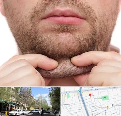 ساکشن غبغب در کوی فیروز تبریز