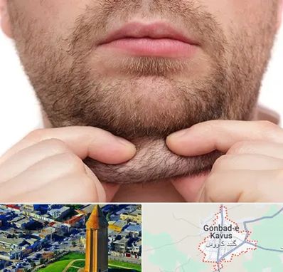 ساکشن غبغب در گنبد کاووس