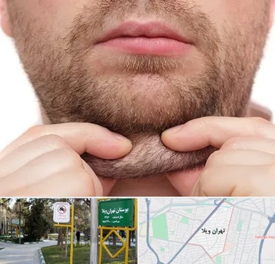 ساکشن غبغب در تهران ویلا