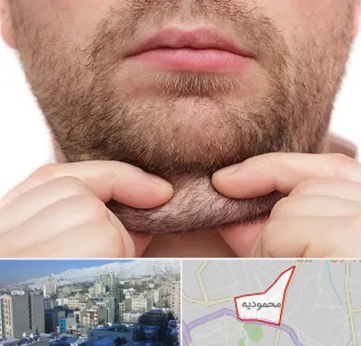ساکشن غبغب در محمودیه