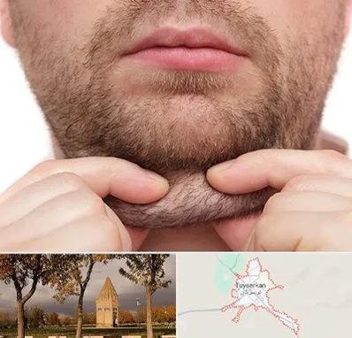 ساکشن غبغب در تویسرکان