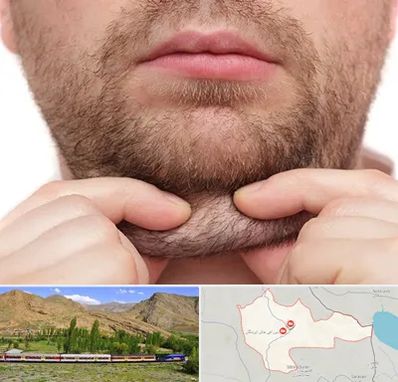 ساکشن غبغب در خاش