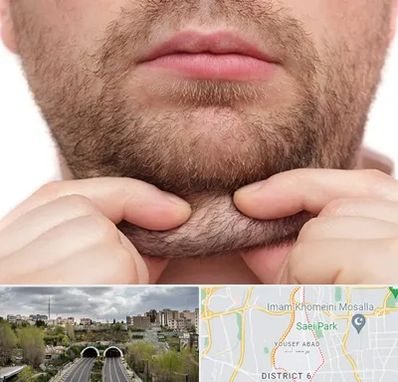 ساکشن غبغب در یوسف آباد 