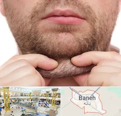 ساکشن غبغب در بانه