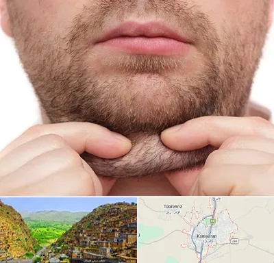 ساکشن غبغب در کامیاران