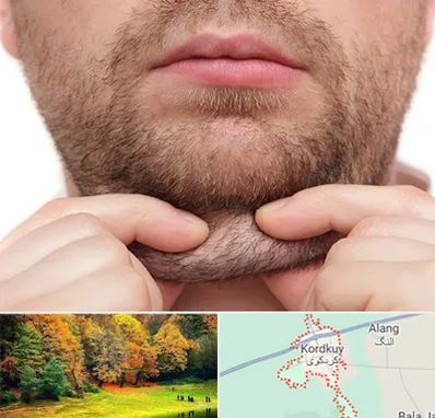 ساکشن غبغب در کردکوی