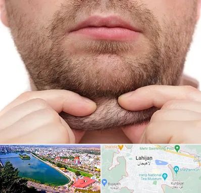 ساکشن غبغب در لاهیجان