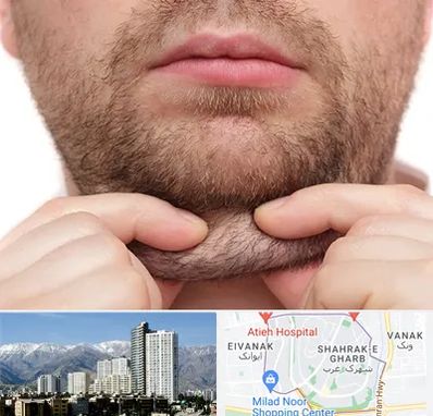 ساکشن غبغب در شهرک غرب 