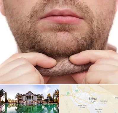 ساکشن غبغب در شیراز