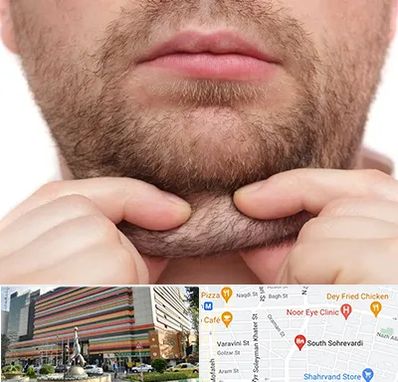 ساکشن غبغب در سهروردی 