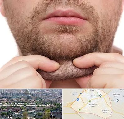 ساکشن غبغب در رباط کریم