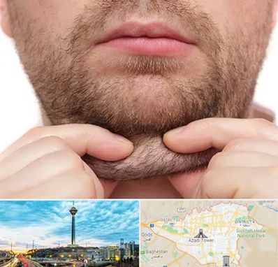 ساکشن غبغب در تهران