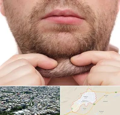 ساکشن غبغب در شاهرود