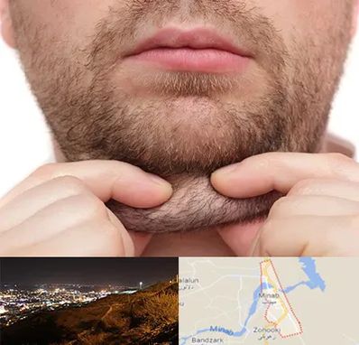 ساکشن غبغب در میناب