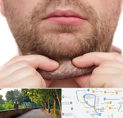 ساکشن غبغب در فلکه گاز رشت 